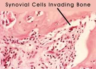 3Synovial Invasion labeled.jpg (16950 bytes)